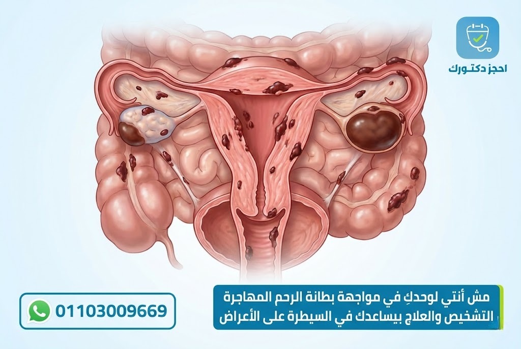 صورة توضيحية لمرض بطانة الرحم المهاجرة وانتشار الأنسجة خارج الرحم داخل الحوض.